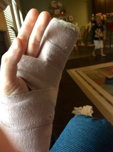 Broken metacarpal